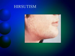 HIRSUTISM
 
