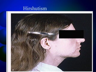 Hirshutism
 