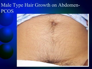 Male Type Hair Growth on Abdomen-
PCOS
 
