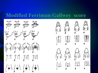 Modified Ferriman Gallwey score
 