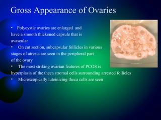 Gross Appearance of Ovaries
• Polycystic ovaries are enlarged and
have a smooth thickened capsule that is
avascular
• On cut section, subcapsular follicles in various
stages of atresia are seen in the peripheral part
of the ovary
• The most striking ovarian features of PCOS is
hyperplasia of the theca stromal cells surrounding arrested follicles
• Microscopically luteinizing theca cells are seen
 