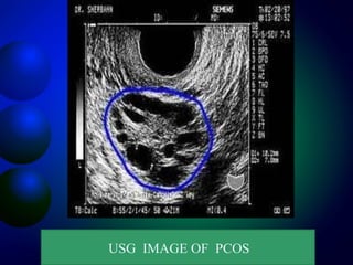 USG IMAGE OF PCOS
 