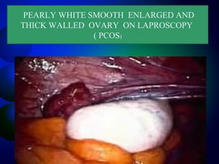 PEARLY WHITE SMOOTH ENLARGED AND
THICK WALLED OVARY ON LAPROSCOPY
( PCOS)
 