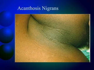Acanthosis Nigrans
 