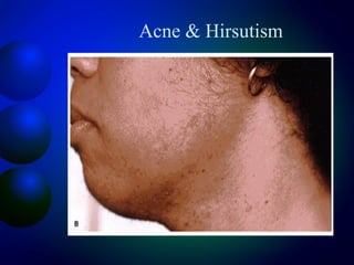 Acne & Hirsutism
 