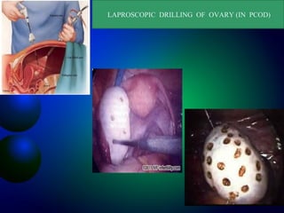 LAPROSCOPIC DRILLING OF OVARY (IN PCOD)
 
