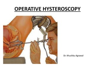 OPERATIVE HYSTEROSCOPY
Dr. Khushbu Agrawal
 