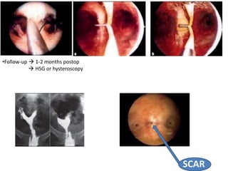 •Follow-up  1-2 months postop
 HSG or hysteroscopy
SCAR
 
