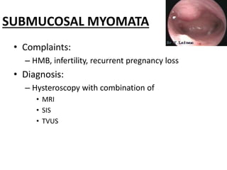 SUBMUCOSAL MYOMATA
• Complaints:
– HMB, infertility, recurrent pregnancy loss
• Diagnosis:
– Hysteroscopy with combination of
• MRI
• SIS
• TVUS
 