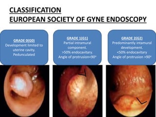 CLASSIFICATION
EUROPEAN SOCIETY OF GYNE ENDOSCOPY
GRADE 0(G0)
Development limited to
uterine cavity.
Pedunculated
GRADE 1(G1)
Partial intramural
component.
>50% endocavitary.
Angle of protrusion<90o
GRADE 2(G2)
Predominantly intamural
development.
<50% endocavitary
Angle of protrusion >90o
 