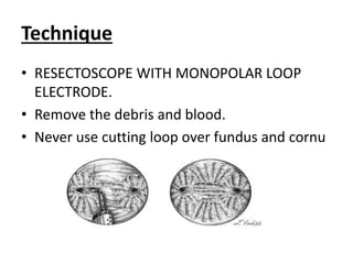 Technique
• RESECTOSCOPE WITH MONOPOLAR LOOP
ELECTRODE.
• Remove the debris and blood.
• Never use cutting loop over fundus and cornu
 