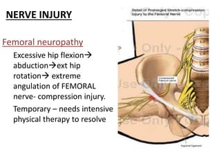 NERVE INJURY
Femoral neuropathy
Excessive hip flexion
abductionext hip
rotation extreme
angulation of FEMORAL
nerve- compression injury.
Temporary – needs intensive
physical therapy to resolve
 