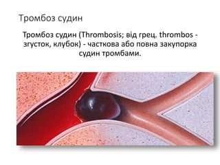 Тромбоз судин
Тромбоз судин (Thrombosis; від грец. thrombos -
згусток, клубок) - часткова або повна закупорка
судин тромбами.
 