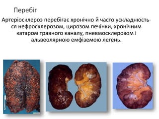 Перебіг
Артеріосклероз перебігає хронічно й часто ускладнюєть-
ся нефросклерозом, цирозом печінки, хронічним
катаром травного каналу, пневмосклерозом і
альвеолярною емфіземою легень.
 