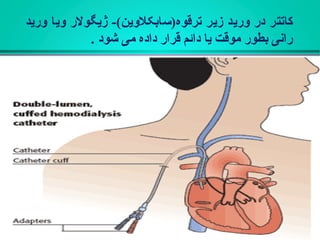 ‫ورید‬ ‫ویا‬ ‫ژیگولر‬ -(‫ترقوه)سابکلوین‬ ‫زیر‬ ‫ورید‬ ‫در‬ ‫کاتتر‬
. ‫شود‬ ‫می‬ ‫داده‬ ‫قرار‬ ‫دائم‬ ‫یا‬ ‫موقت‬ ‫بطور‬ ‫رانی‬
 