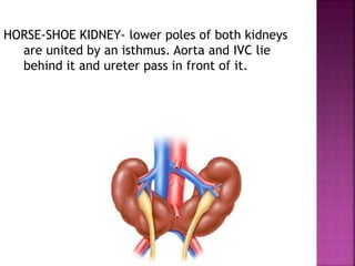 HORSE-SHOE KIDNEY- lower poles of both kidneys
are united by an isthmus. Aorta and IVC lie
behind it and ureter pass in front of it.
 