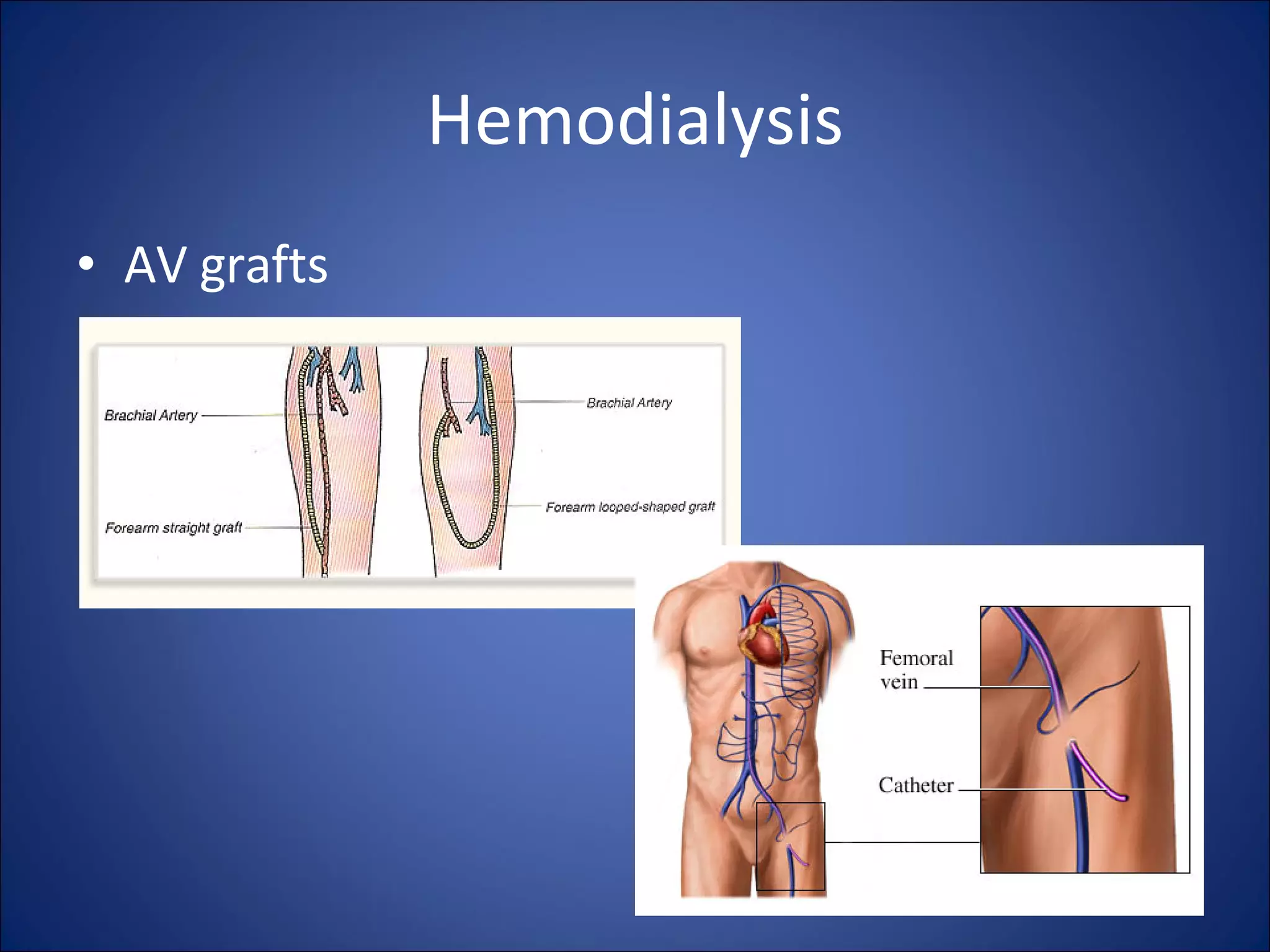 Hemodialysis AV grafts 