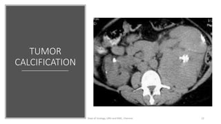 CLINICAL FEATURES & PROGNOSTIC FACTORS OF RCC | PDF