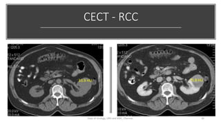 Small Rcc Usg CLINICAL FEATURES & PROGNOSTIC FACTORS OF RCC | PDF