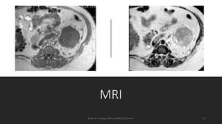 Small Rcc Mri CLINICAL FEATURES & PROGNOSTIC FACTORS OF RCC | PDF