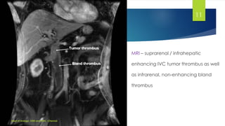 MANAGEMENT OF LOCALLY ADVANCED RENAL CELL CARCINOMA | PDF
