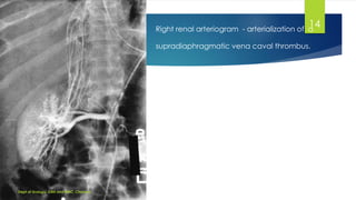 MANAGEMENT OF LOCALLY ADVANCED RENAL CELL CARCINOMA | PDF