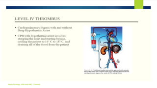 MANAGEMENT OF LOCALLY ADVANCED RENAL CELL CARCINOMA | PDF