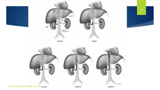 MANAGEMENT OF LOCALLY ADVANCED RENAL CELL CARCINOMA | PDF