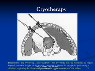 Cynoprobe Installation SMALL RENAL MASS | PDF