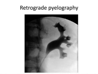 Retrograde pyelography
 