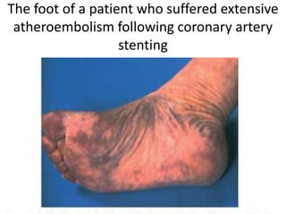 The foot of a patient who suffered extensive
 atheroembolism following coronary artery
                   stenting
 