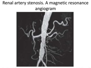 Renal artery stenosis. A magnetic resonance
                 angiogram
 