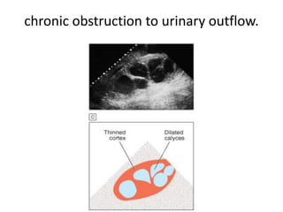 chronic obstruction to urinary outflow.
 
