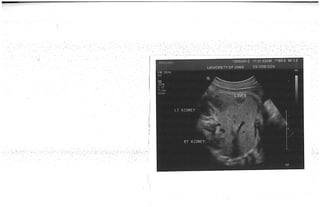  Kidney and liver Prenatal Ultrasound normal fetus