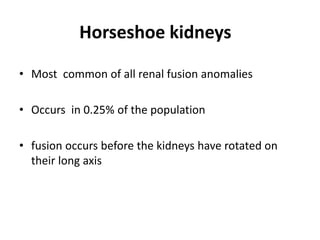 • Most common of all renal fusion anomalies
• Occurs in 0.25% of the population
• fusion occurs before the kidneys have rotated on
their long axis
Horseshoe kidneys
 