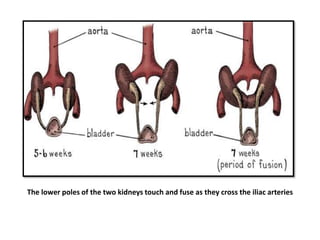 The lower poles of the two kidneys touch and fuse as they cross the iliac arteries
 