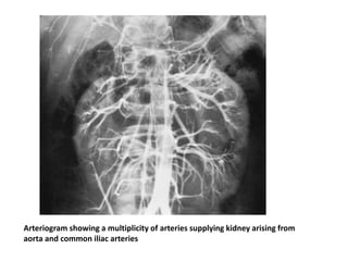Arteriogram showing a multiplicity of arteries supplying kidney arising from
aorta and common iliac arteries
 