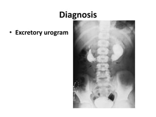 Diagnosis
• Excretory urogram
 