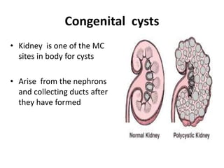 Congenital cysts
• Kidney is one of the MC
sites in body for cysts
• Arise from the nephrons
and collecting ducts after
they have formed
 