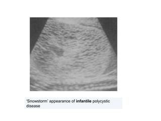 ‘Snowstorm’ appearance of infantile polycystic
disease
 