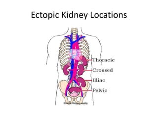 Ectopic Kidney Locations
 