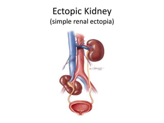 Ectopic Kidney
(simple renal ectopia)
 