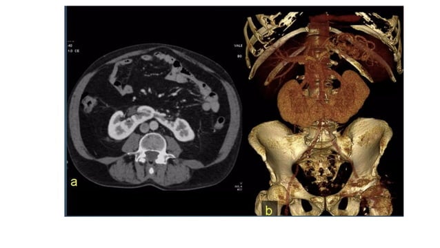 KIDNEY AND URINARY TRACT IMAGING AND FINDINGS | PPTX
