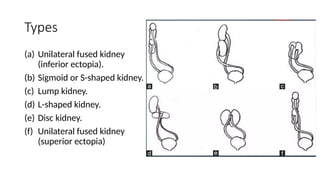 Disc Kidney KIDNEY AND URINARY TRACT IMAGING AND FINDINGS | PPTX