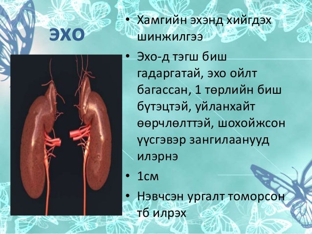 Kidney cancer бөөрний хавдар