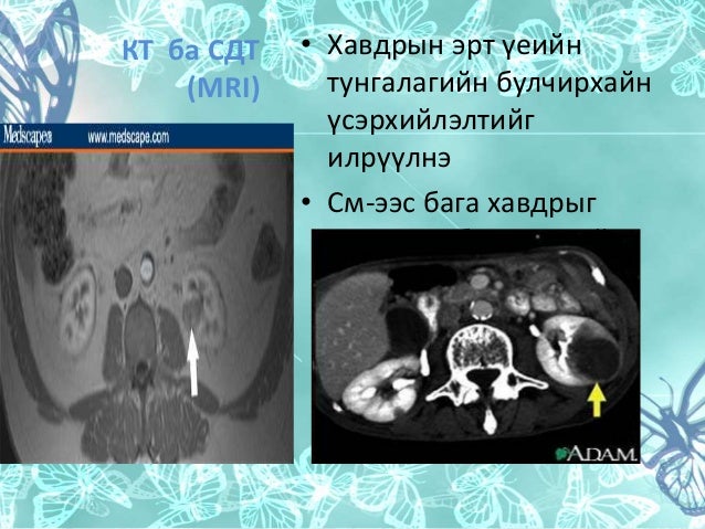 Kidney cancer бөөрний хавдар