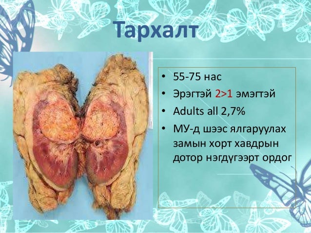 Kidney cancer бөөрний хавдар