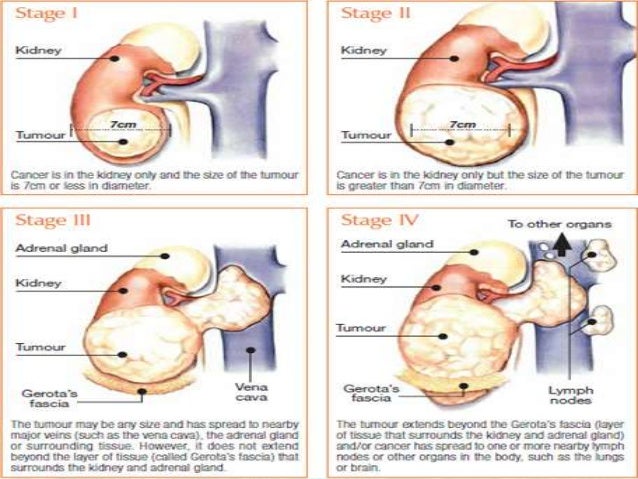 Kidney cancer бөөрний хавдар