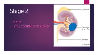 Stage 2
 ≥7CM
 STILL CONFINED TO KIDNEY
 