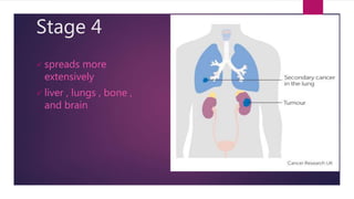 Stage 4
 spreads more
extensively
 liver , lungs , bone ,
and brain
 